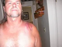 BrokenCollarbone004_zps76de8282.webp